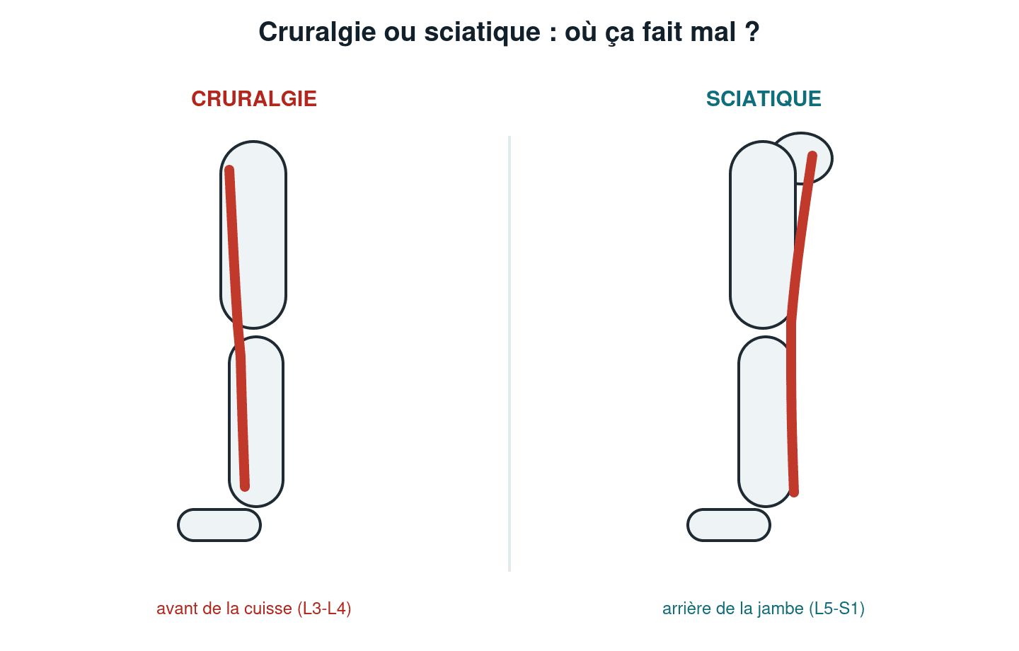 Schéma comparant la cruralgie (douleur à l'avant de la cuisse, L3-L4) et la sciatique (douleur à l'arrière de la jambe, L5-S1)