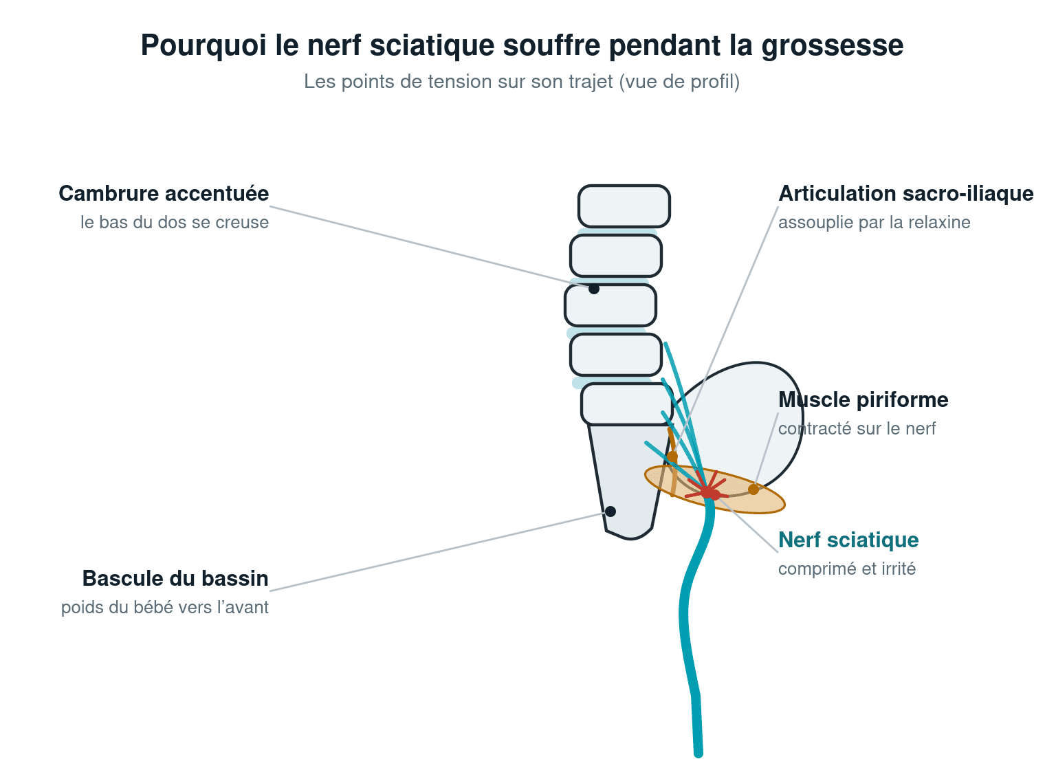 Schéma médical du nerf sciatique pendant la grossesse : cambrure accentuée, bascule du bassin, articulation sacro-iliaque assouplie et muscle piriforme comprimant le nerf