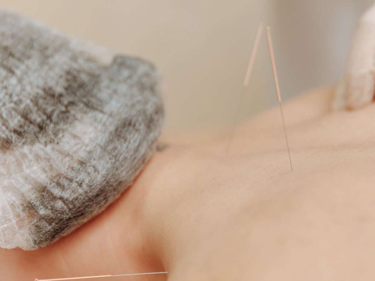 Aiguilles d'acupuncture posées sur le bas du dos pendant une séance pour soulager une sciatique