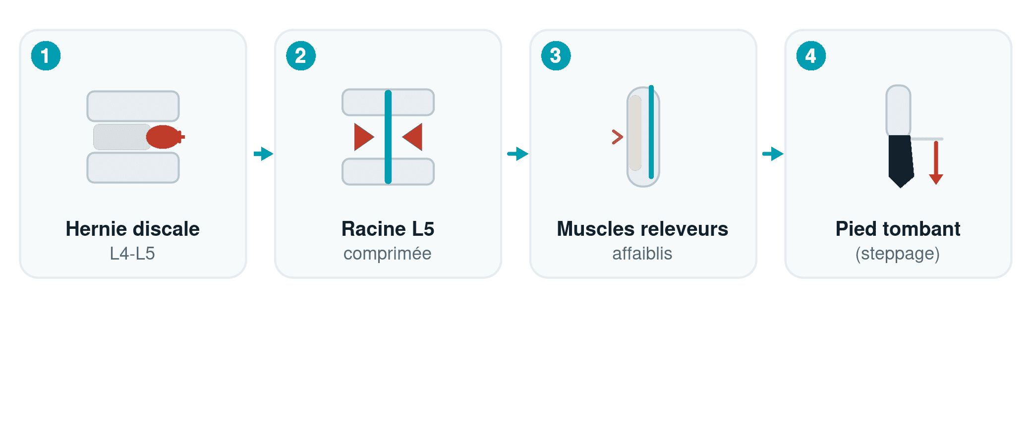 Schéma du mécanisme du pied tombant : la hernie discale L4-L5 comprime la racine L5, les muscles releveurs faiblissent et le pied tombe