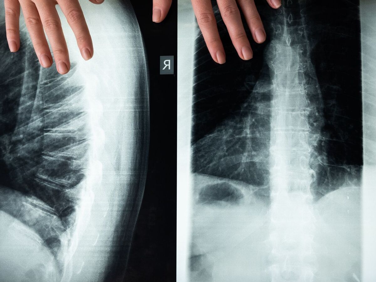 Médecin examinant une radiographie de la colonne vertébrale pour localiser une hernie discale L4-L5 ou L5-S1