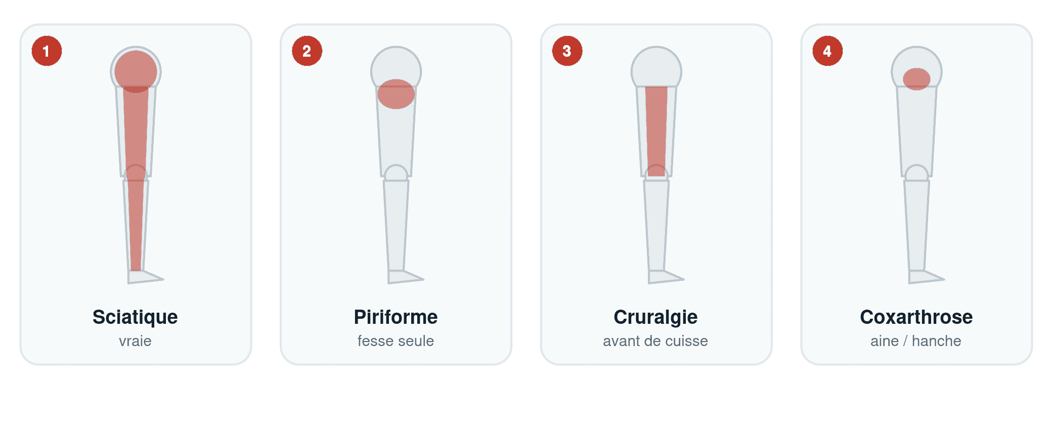 Schéma comparant la zone de douleur de la sciatique vraie, du syndrome du piriforme, de la cruralgie et de la coxarthrose