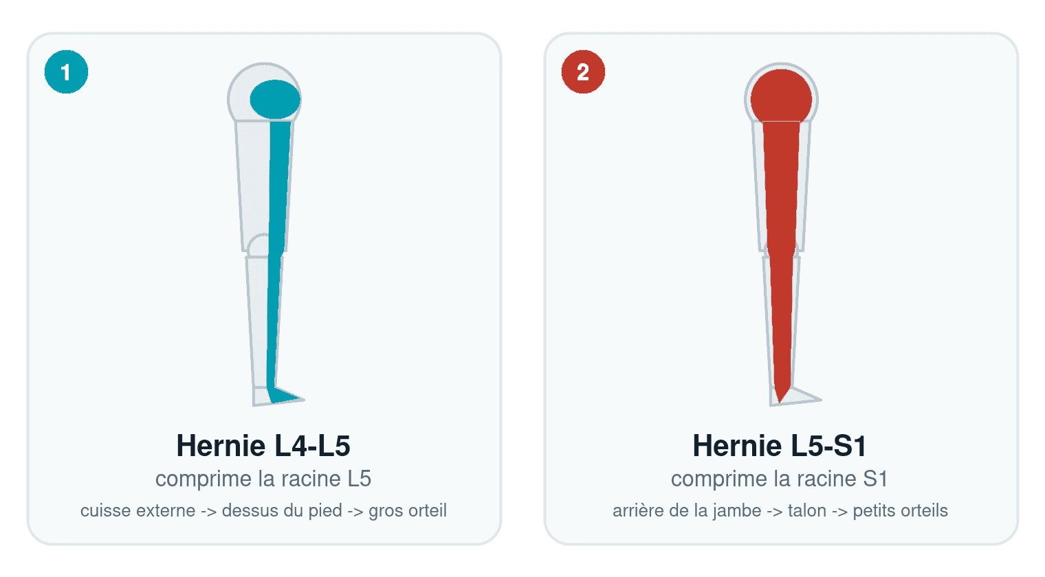 Schéma comparant le trajet de la douleur d'une hernie discale L4-L5 (racine L5) et d'une hernie L5-S1 (racine S1)