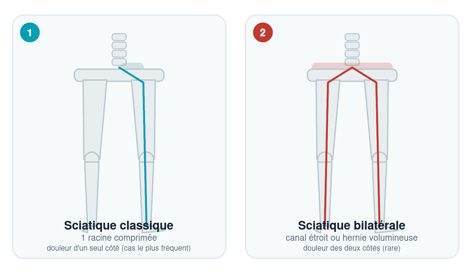 Schéma comparant la sciatique classique (1 racine nerveuse comprimée, douleur d'un seul côté) et la sciatique bilatérale (canal étroit ou hernie volumineuse, douleur des deux côtés)