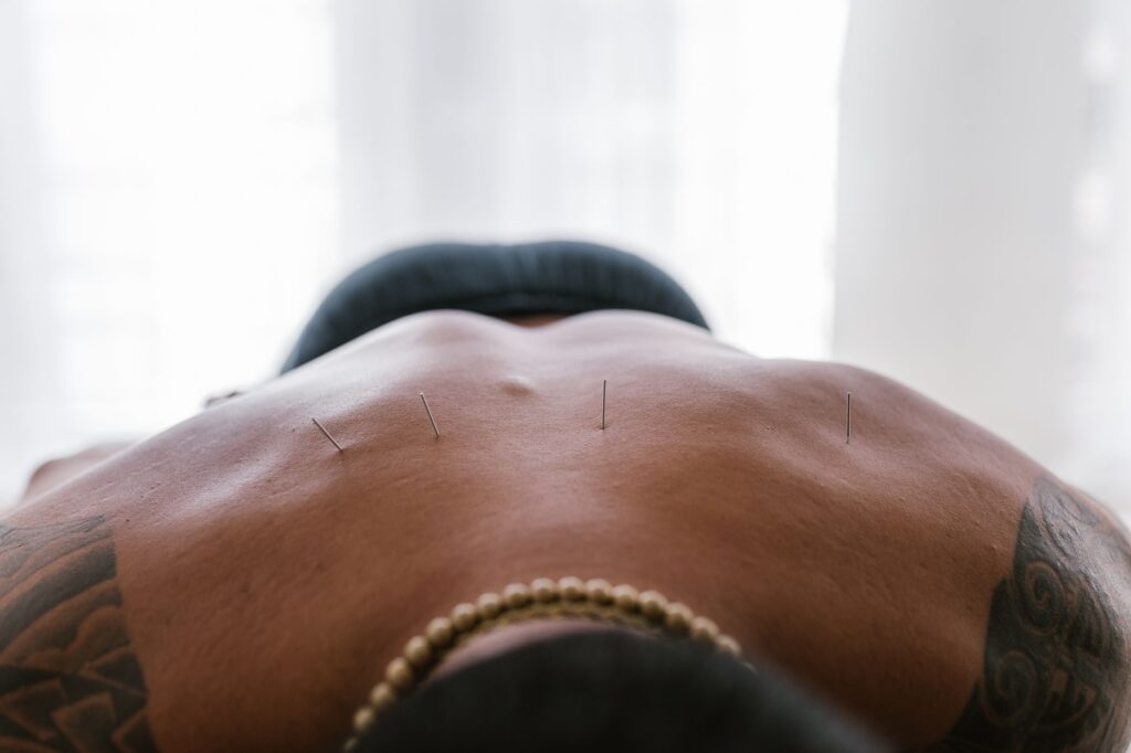 Aiguilles d'acupuncture posées dans le dos